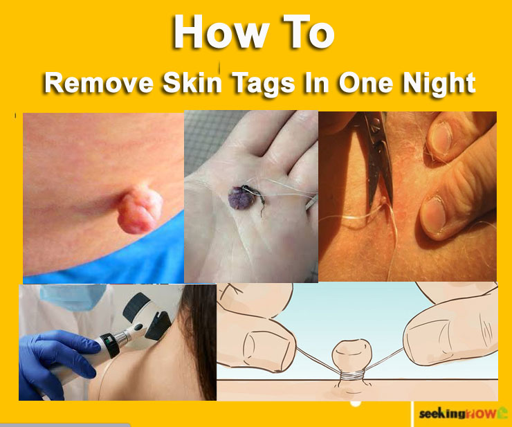How To Remove Skin Tags In One Night